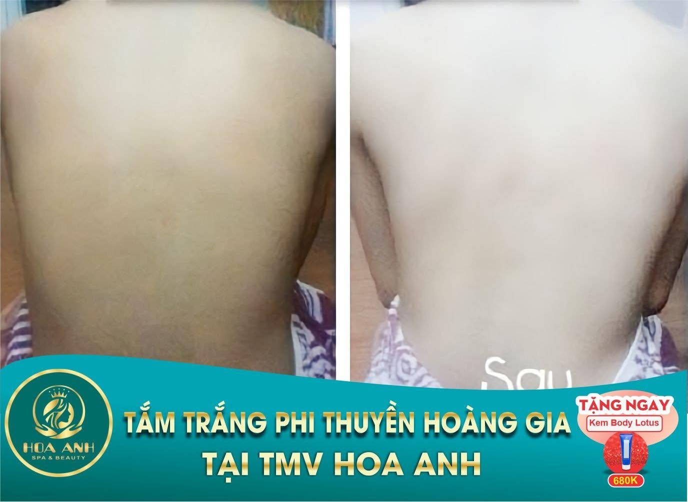 Trước và sau tắm trắng Phi Thuyền Hoàng Gia vùng lưng tại Hoa Anh — ca 2